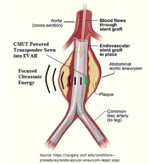 Aortawatch – An ultrasound-enabled implantable device for monitoring patients after endovascular aneurysm repairs. 